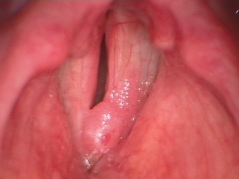 Papillomatosi laringea prima dell'intervento chirurgico