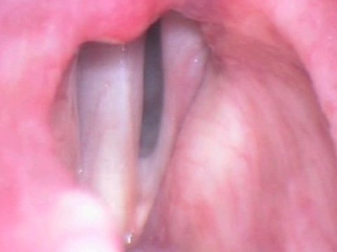 Corde vocali prima dell'iniezione di grasso