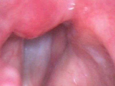 Corde vocali dopo l'iniezione di grasso