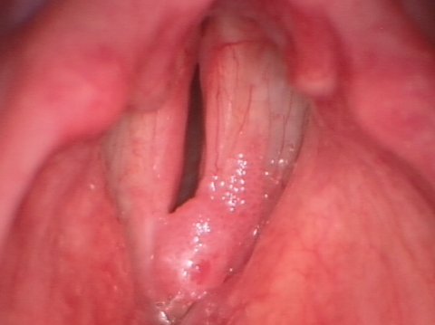 Papilloma delle corde vocali
