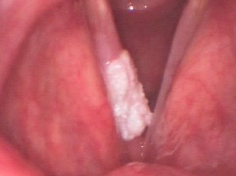 Carcinoma epiteliale piatto della corda vocale