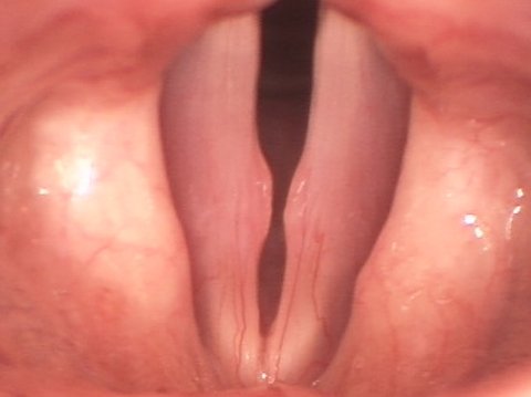 Noduli alle corde vocali