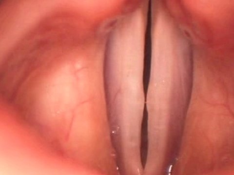 Noduli delle corde vocali