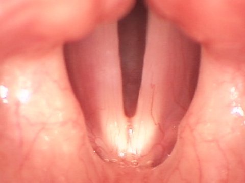 Noduli alle corde vocali dopo l'intervento
