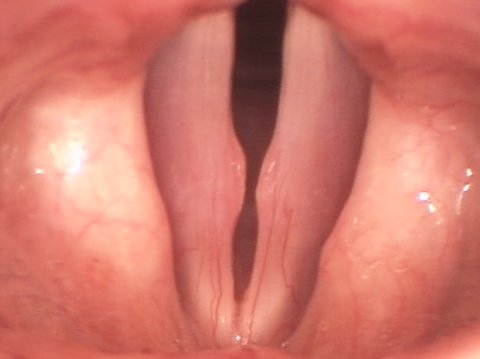 Noduli alle corde vocali prima dell'intervento