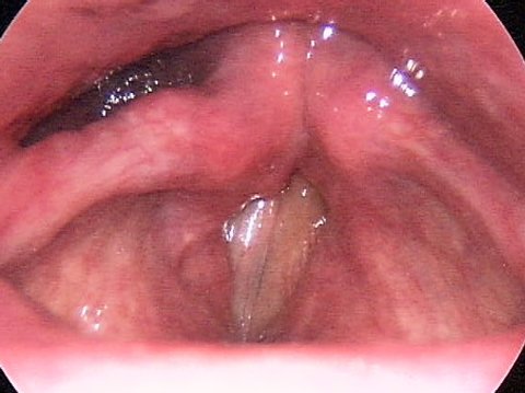 Paralisi delle corde vocali dopo l'intervento