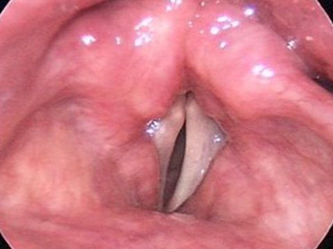 Paralisi delle corde vocali prima dell'intervento