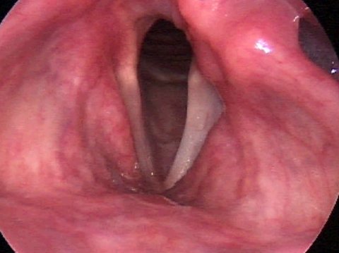 Paralisi delle corde vocali nella respirazione