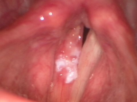 Leucoplachia delle corde vocali, prima dell'intervento