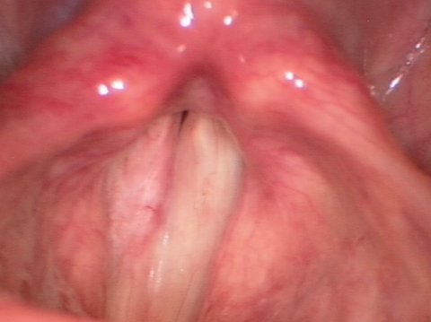 Leucoplachia delle corde vocali dopo l’intervento