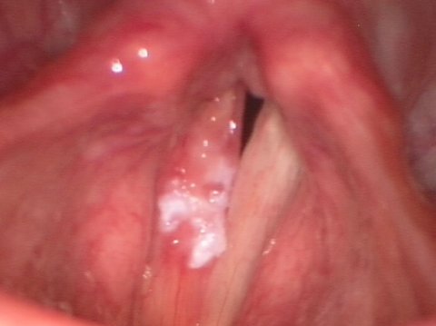 Leucoplachia delle corde vocali
