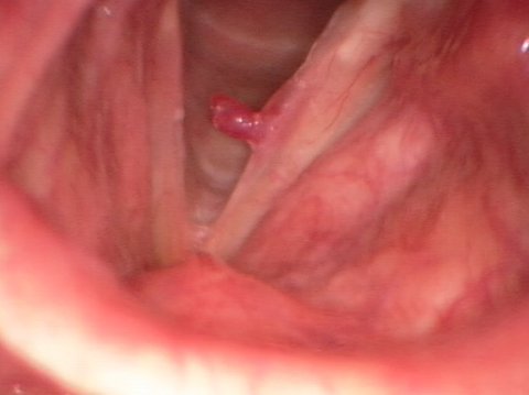 Polipo emorragico alle corde vocali