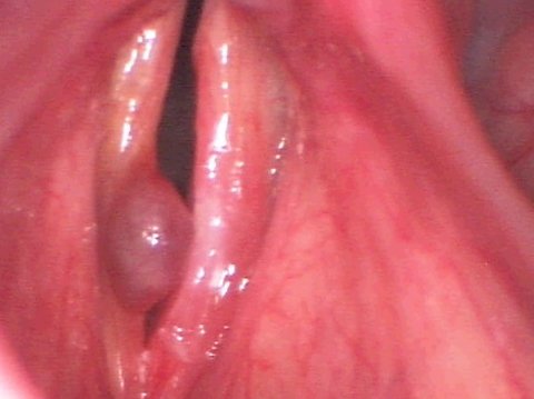 Grande polipo emorragico alle corde vocali