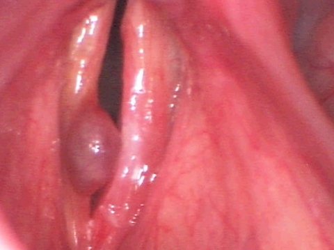 Polipo delle corde vocali prima dell'intervento