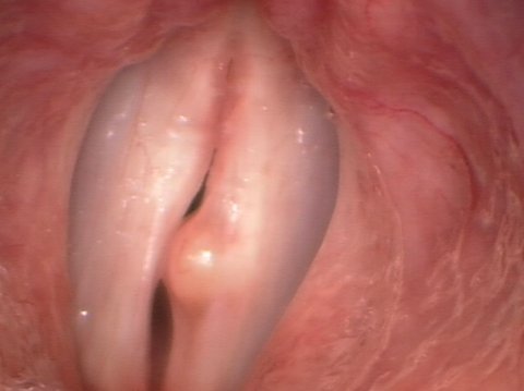 Medium-sized vocal cord cyst