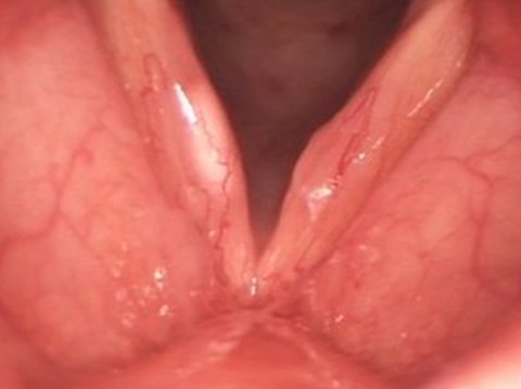 Cisti delle corde vocali prima dell'intervento