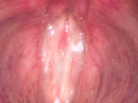 Le pliche vocali dopo la chirurgia anti-invecchiamento