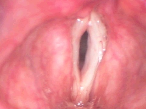 Le pliche vocali prima dell’intervento chirurgico anti-invecchiamento